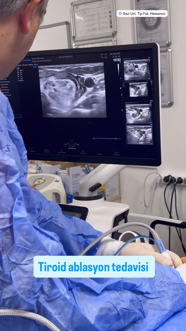 Thyroid Ablation — Successful Case