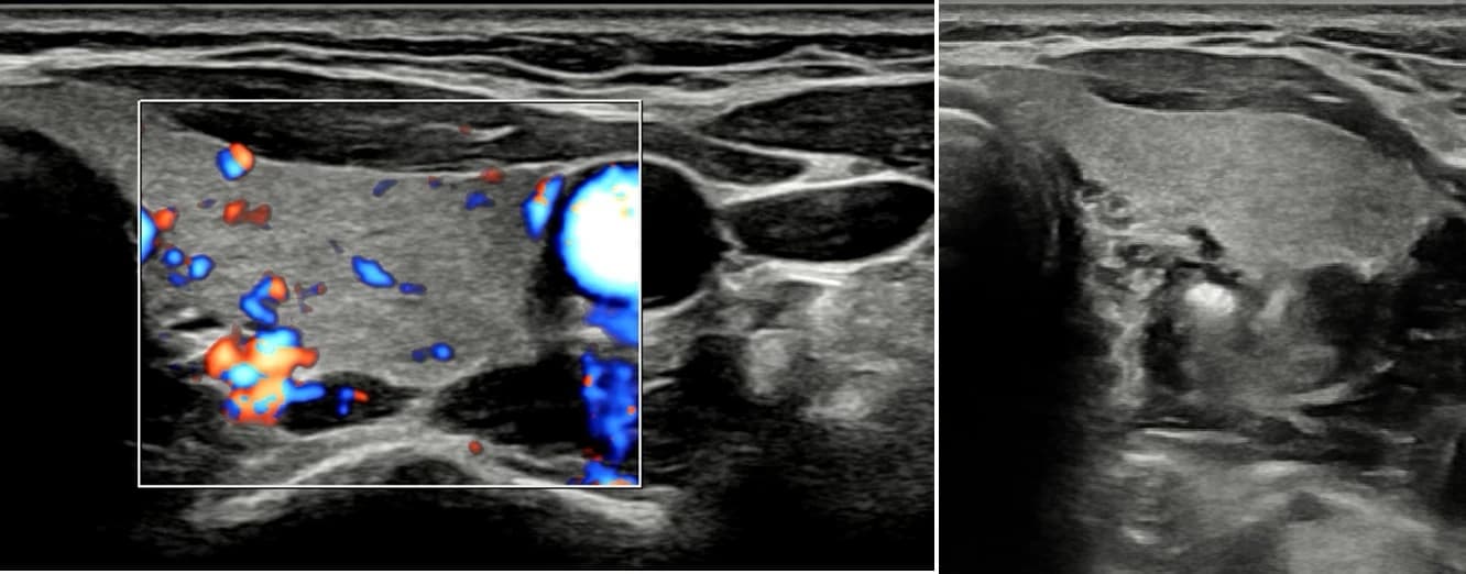 Paratiroid adenomunun ultrason ve renkli Doppler görünümü — tedavi öncesi değerlendirme